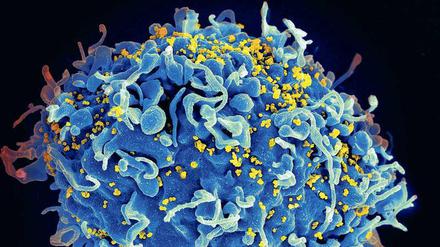 Gelbe Gefahr. Die rasterelektronenmikroskopische Aufnahme zeigt gelb eingefärbte Immunschwächeviren auf der Oberfläche einer blau eingefärbten T-Zelle. Diese Zellen gehören zum Immunsystem des Organismus und sind das Hauptziel des Aids-Erregers. 