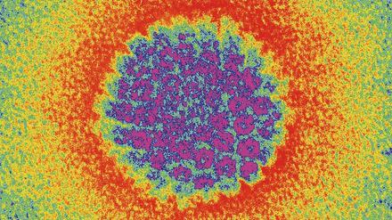 Das Epstein-Barr-Virus gehört zu den Herpes-Viren. Deren Erbgut (lila) besteht aus DNA, die von einer Kapsel umgeben ist. 