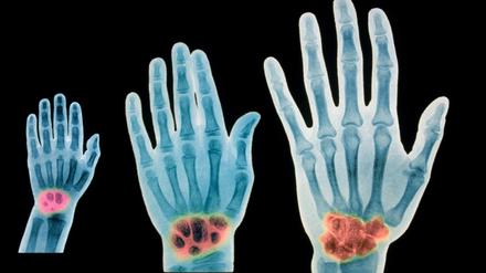 Die Röntgenuntersuchung der Handwurzelknochen (links von einem Zweijährigen, mittig von einem Siebenjährigen und rechts von einem Erwachsenen) soll sich das Alter junger Menschen auf etwa ein Jahr genau bestimmen lassen. 
